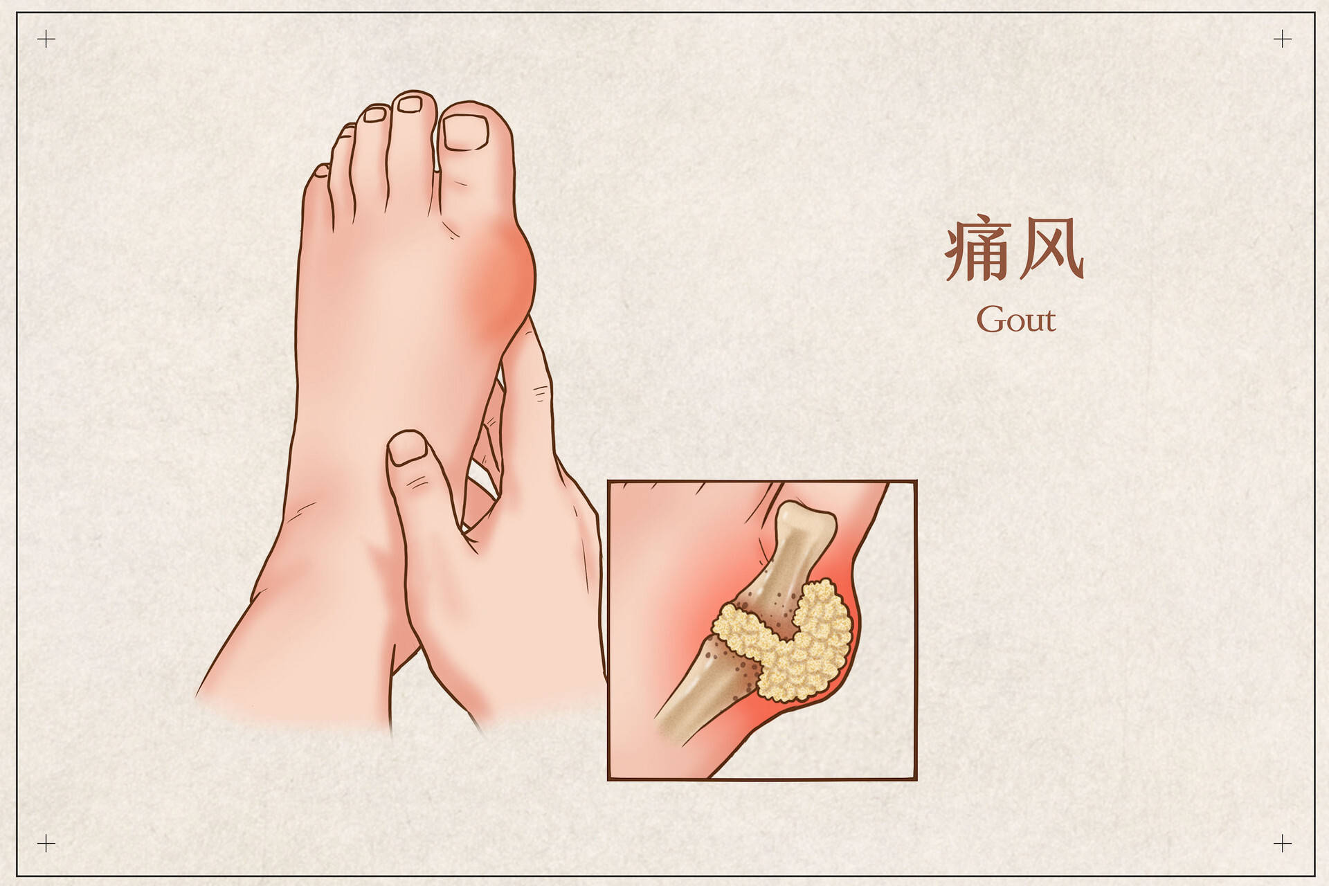 高尿酸、痛風(fēng)，到底能不能吃豆類？